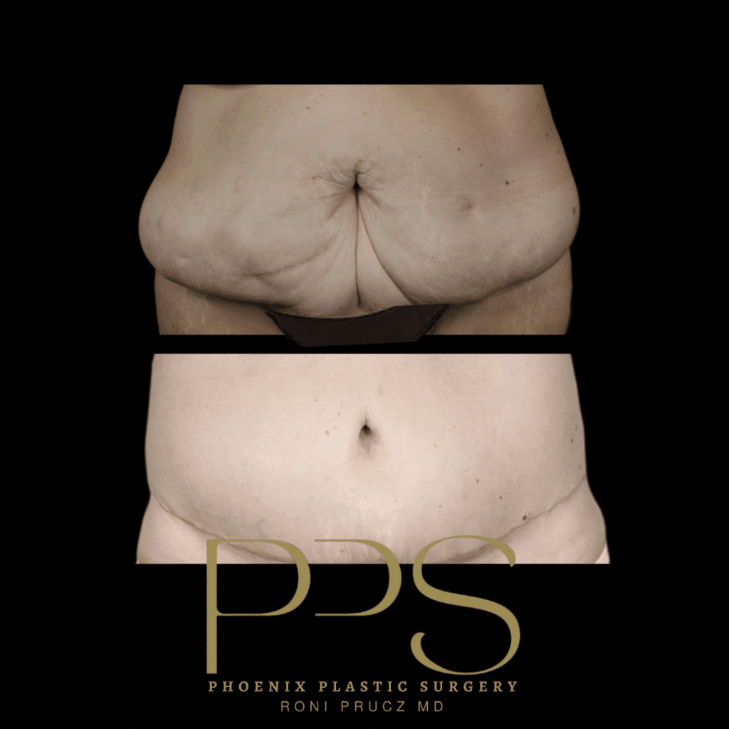 Before and After Photograph of Large Tummy Tuck Phoenix Arizona