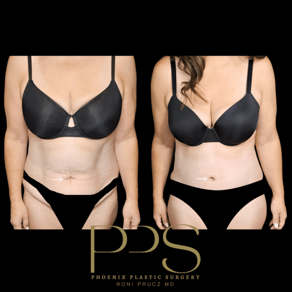 Before and After Photograph of Tummy Tuck Scottsdale Arizona