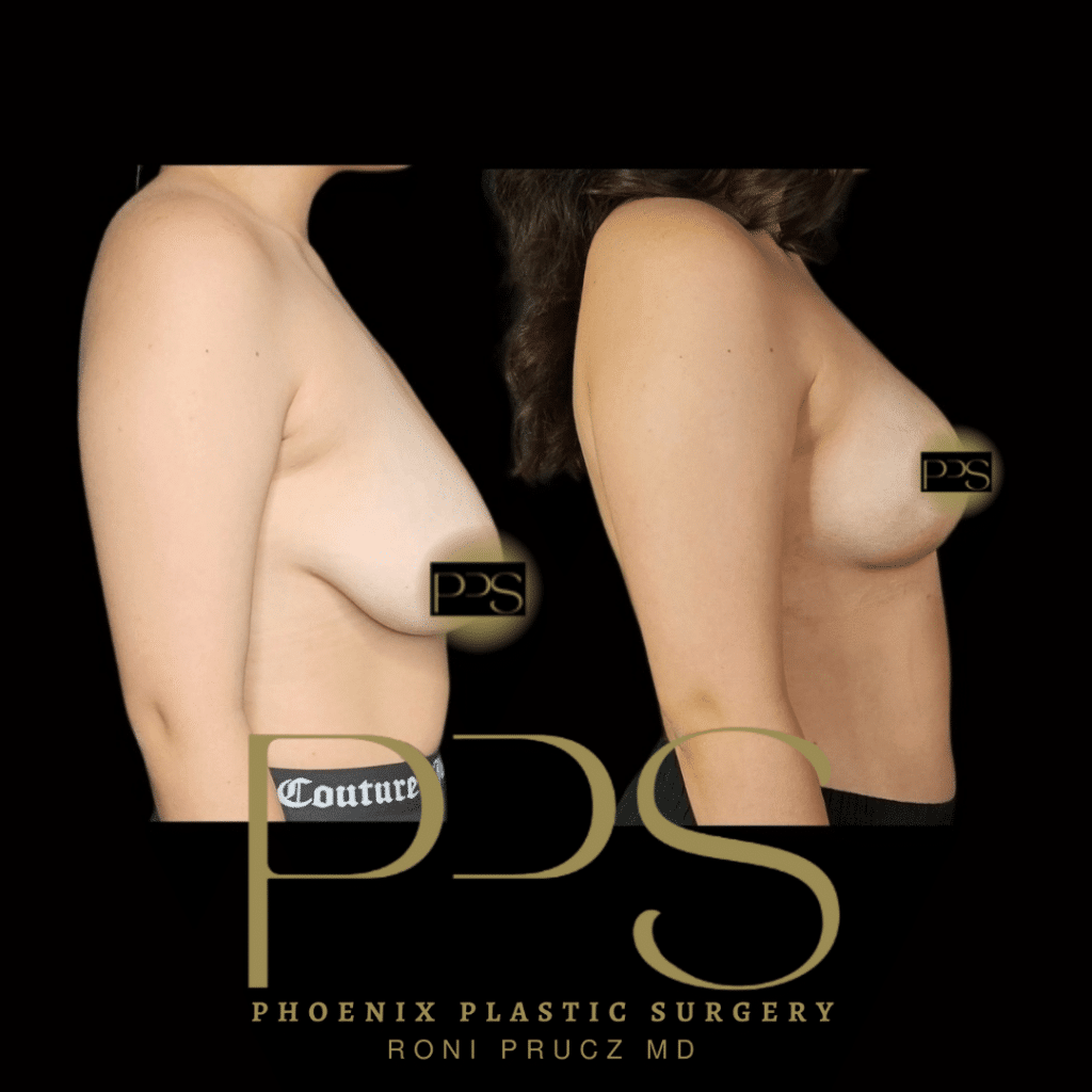 Before and After Photo Breast Reduction Paradise Valley Arizona