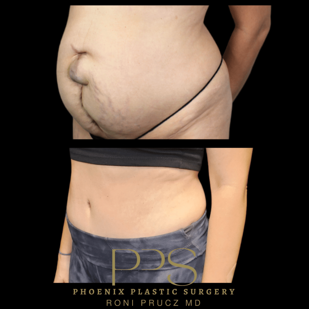 Before and After Photograph of Hernia Repair and Tummy Tuck Phoenix Arizona