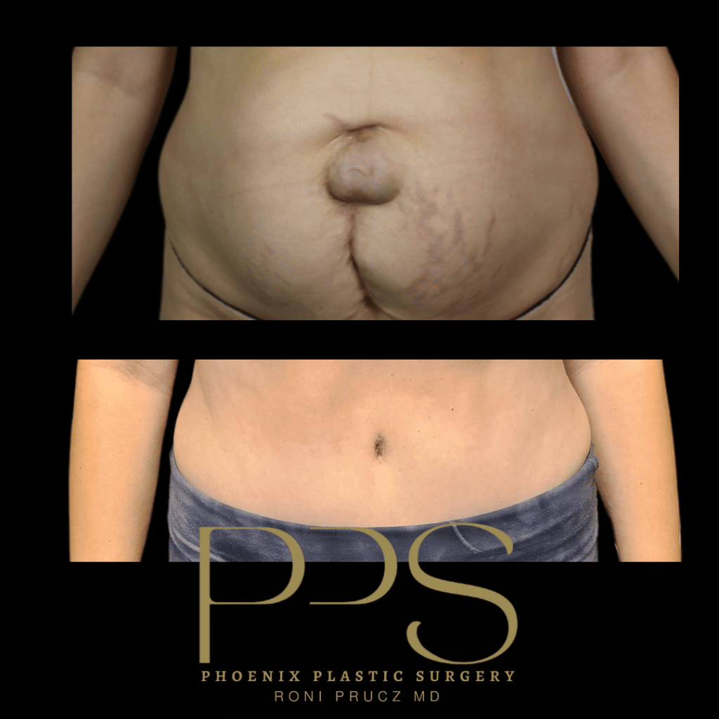 Before and After Photograph of Hernia Repair and Tummy Tuck Phoenix Arizona