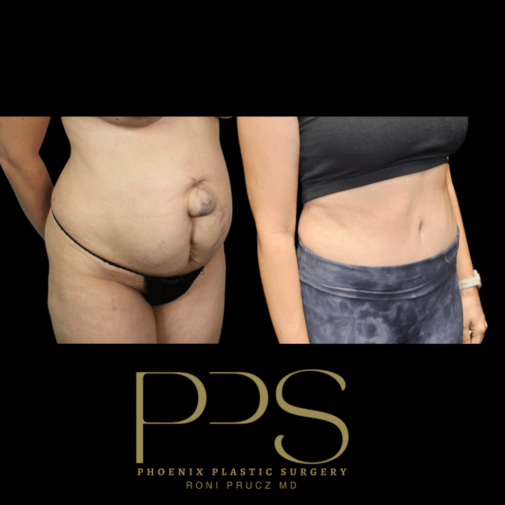 Before and After Photograph of Hernia Repair and Tummy Tuck Phoenix Arizona