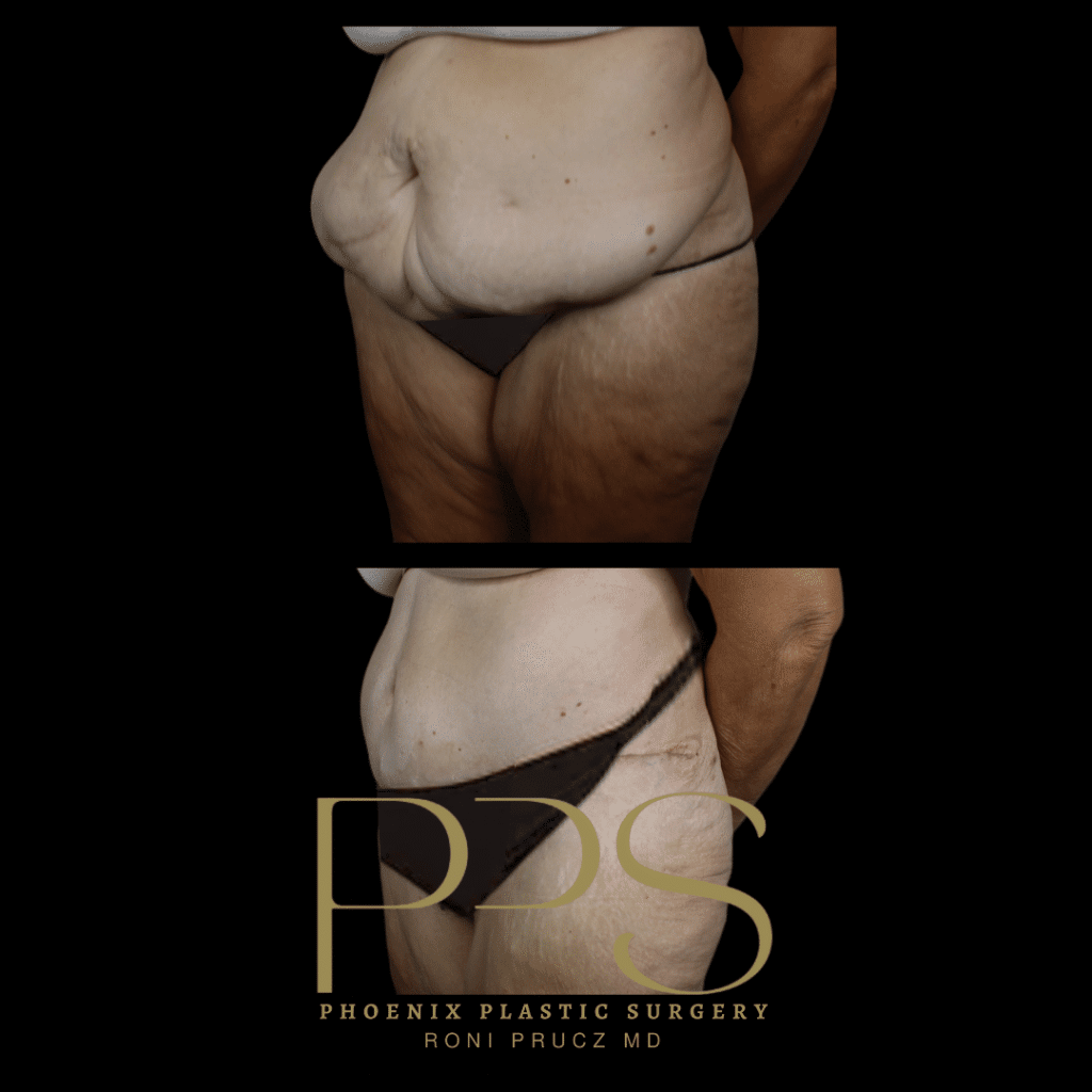 Before and After Photograph of Large Tummy Tuck Phoenix Arizona