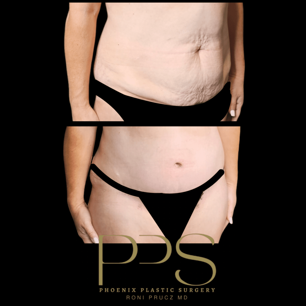 Before and After Photograph of Small Tummy Tuck Phoenix Arizona