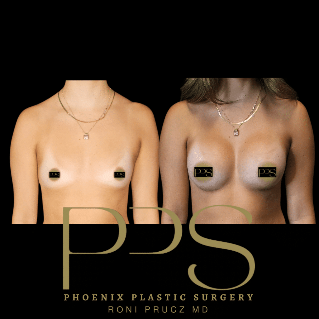 Before and After Photograph of Breast Augmentation Phoenix Arizona