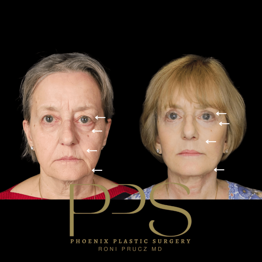 Before and After Photographs of Blepharoplasty, Facelift and Neck Lift Scottsdale Arizona