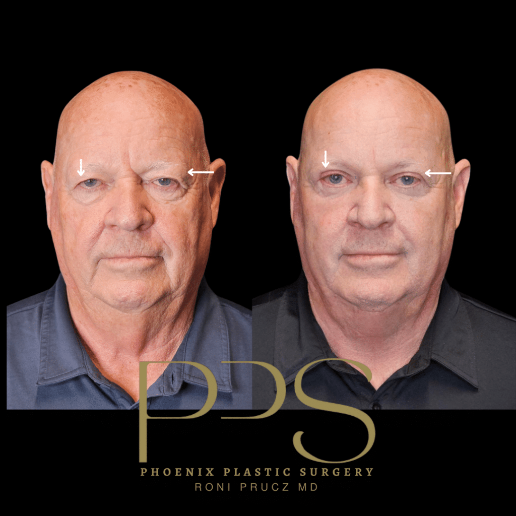 Before and After Photographs of Blepharoplasty and Mini Neck Lift