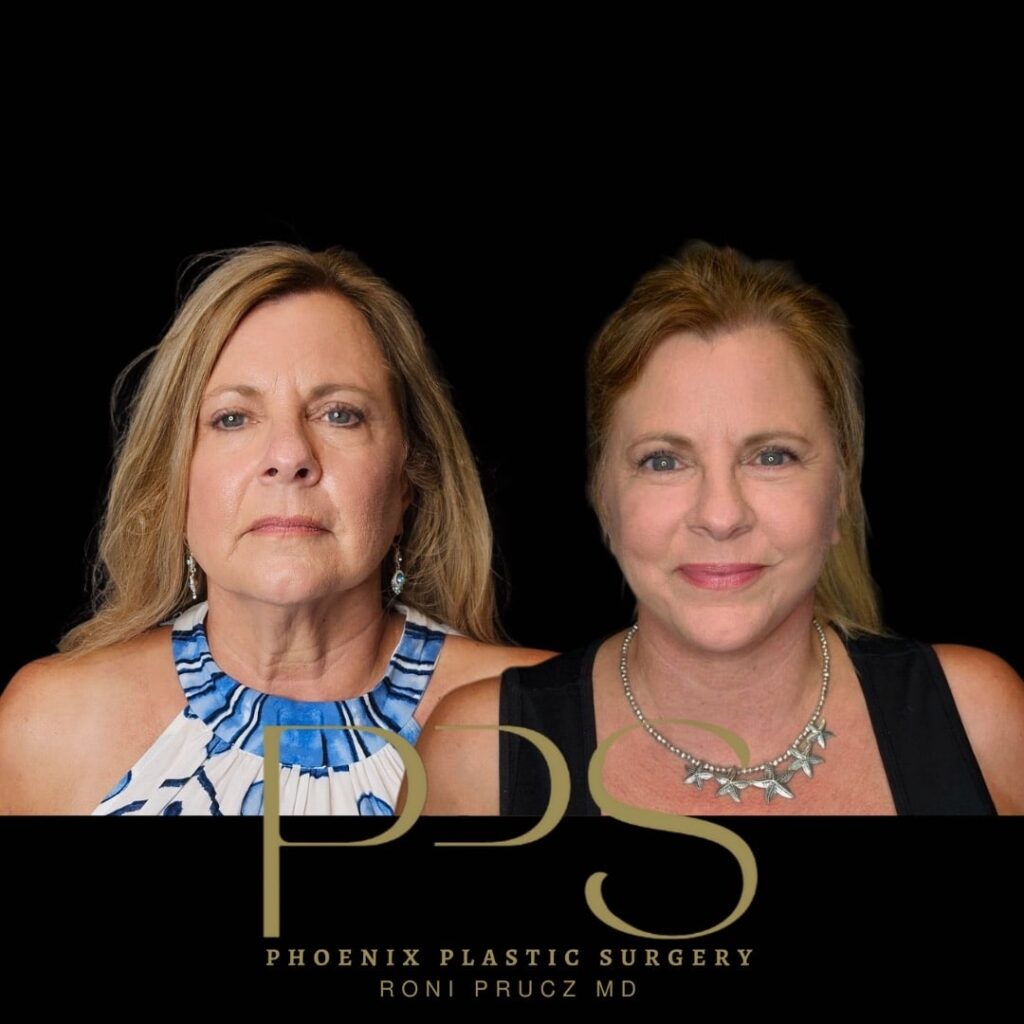 Before and After Photographs of Facelift and Neck Lift Phoenix Arizona