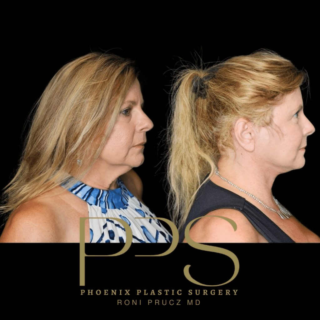 Before and After Photographs of Facelift and Neck Lift Phoenix Arizona