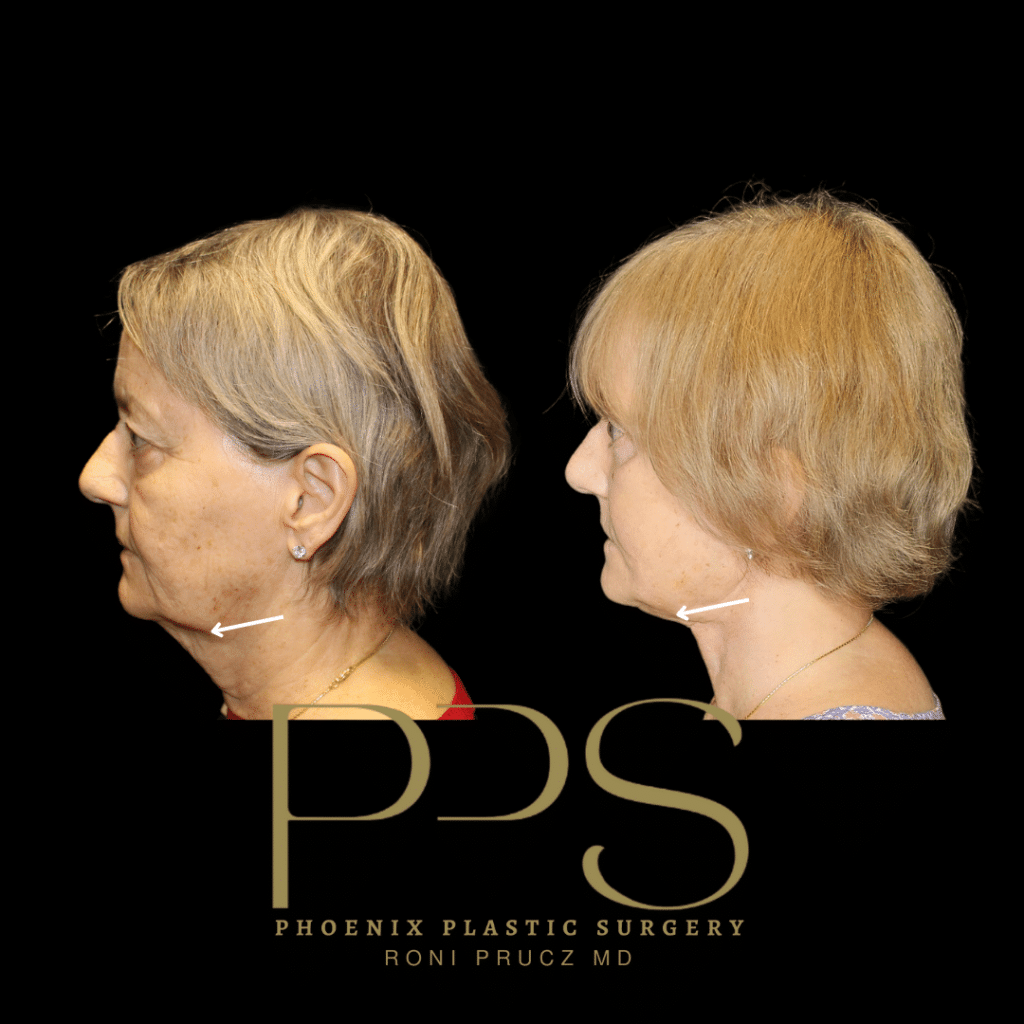 Before and After Photographs of Blepharoplasty, Facelift and Neck Lift Scottsdale Arizona