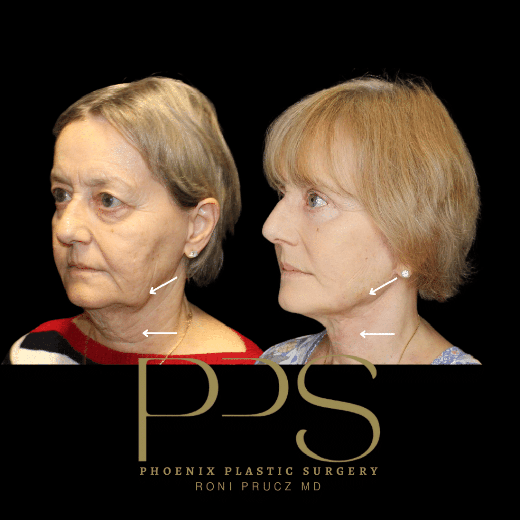 Before and After Photographs of Blepharoplasty, Facelift and Neck Lift Scottsdale Arizona