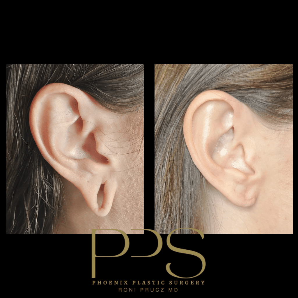 Before and After Photo of Loop Gauge Ear Repair Phoenix Arizona