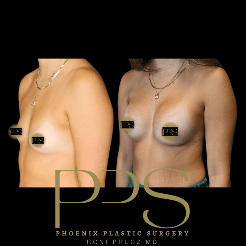 Before and After Photograph of Breast Augmentation Scottsdale Arizona