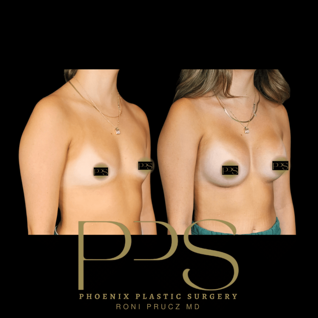 Before and After Photograph of Breast Augmentation Phoenix Arizona