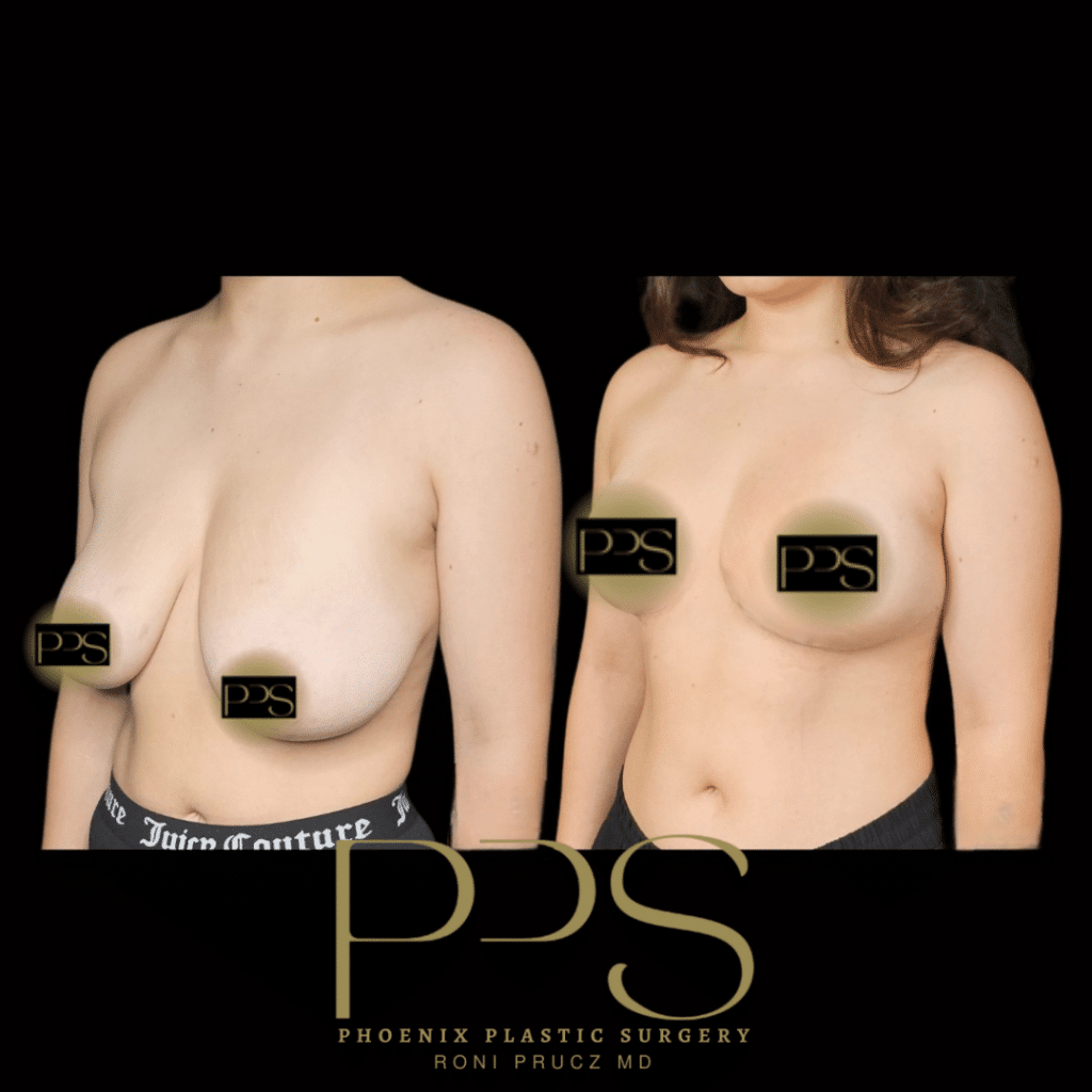 Before and After Photo Breast Reduction Scottsdale Arizona