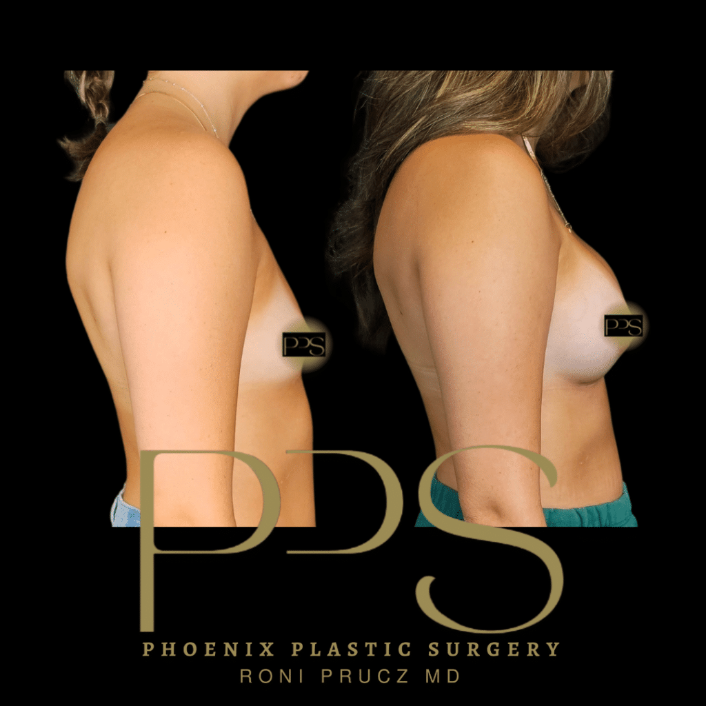 Before and After Photograph of Breast Augmentation Phoenix Arizona