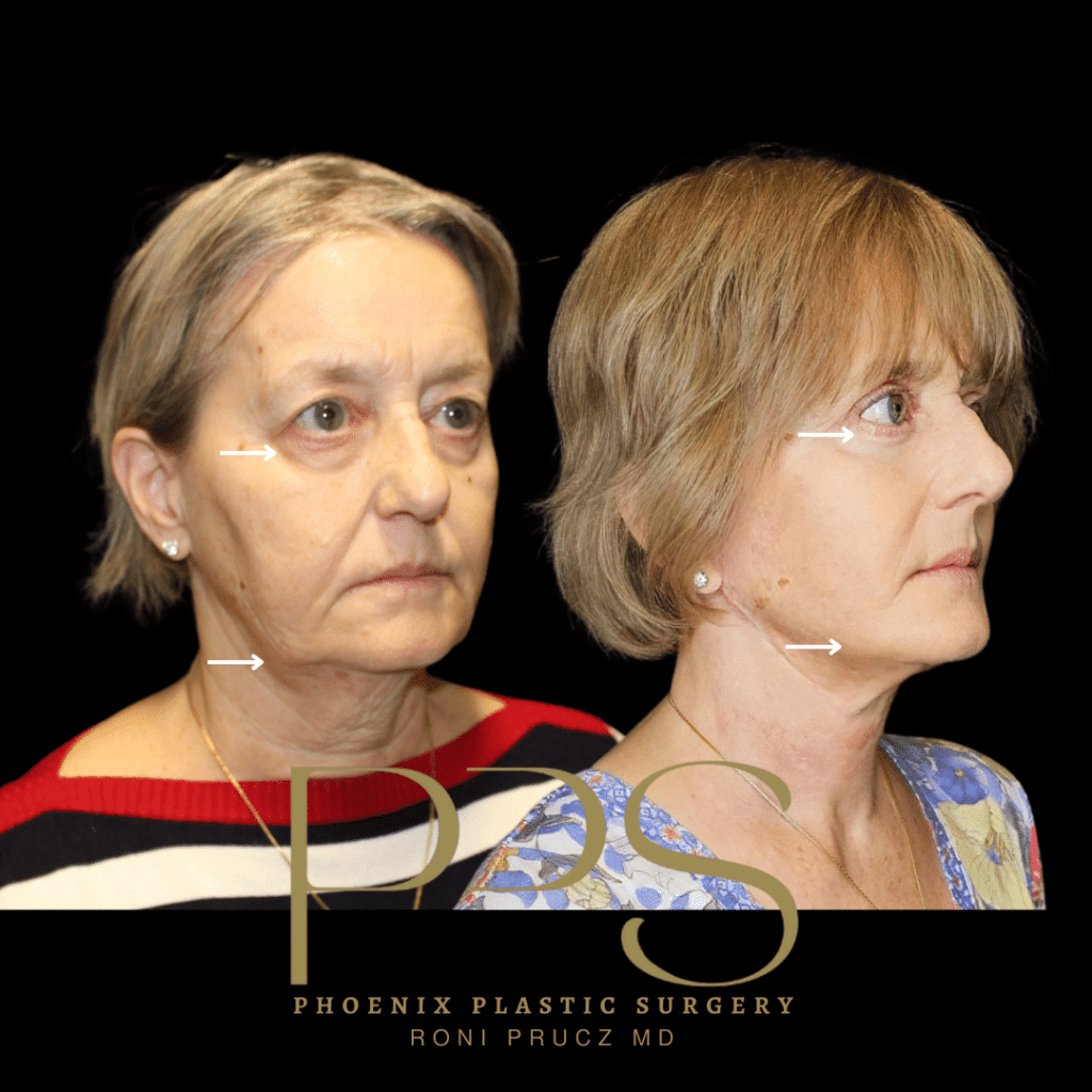 Before and After Photographs of Blepharoplasty, Facelift and Neck Lift Scottsdale Arizona