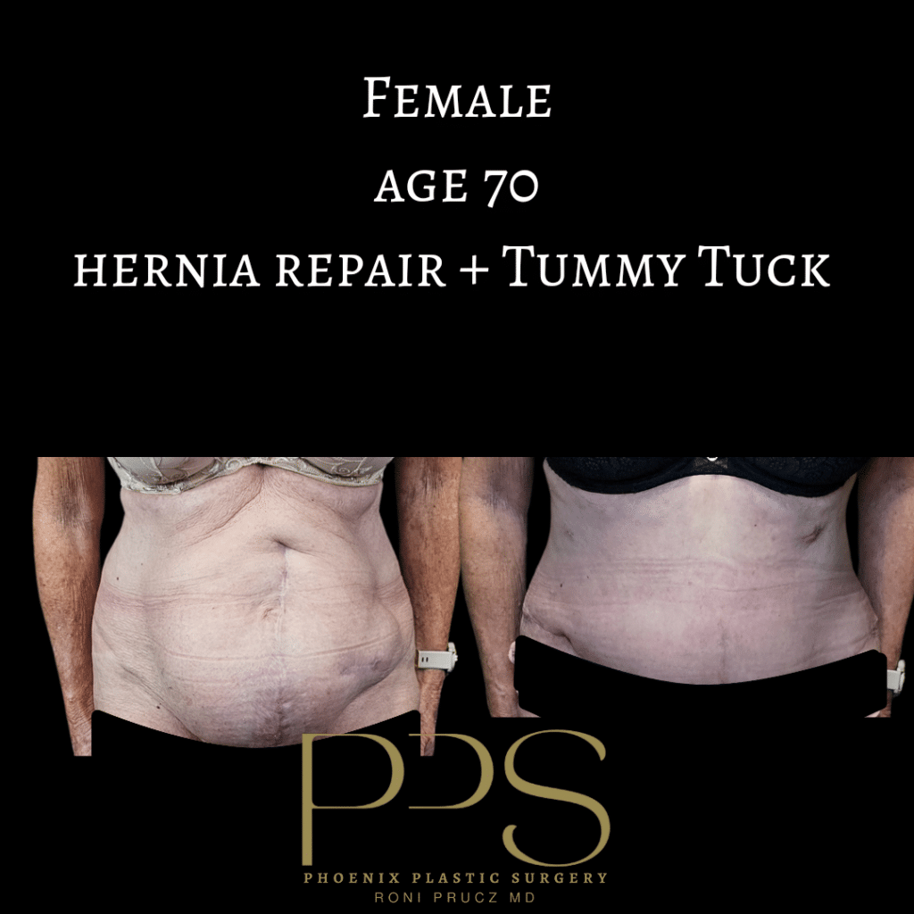 before-and-after-photograph-large-hernia-repair-with-tummy-tuck-anterior-view-70-year-old-female-phoenix-arizona