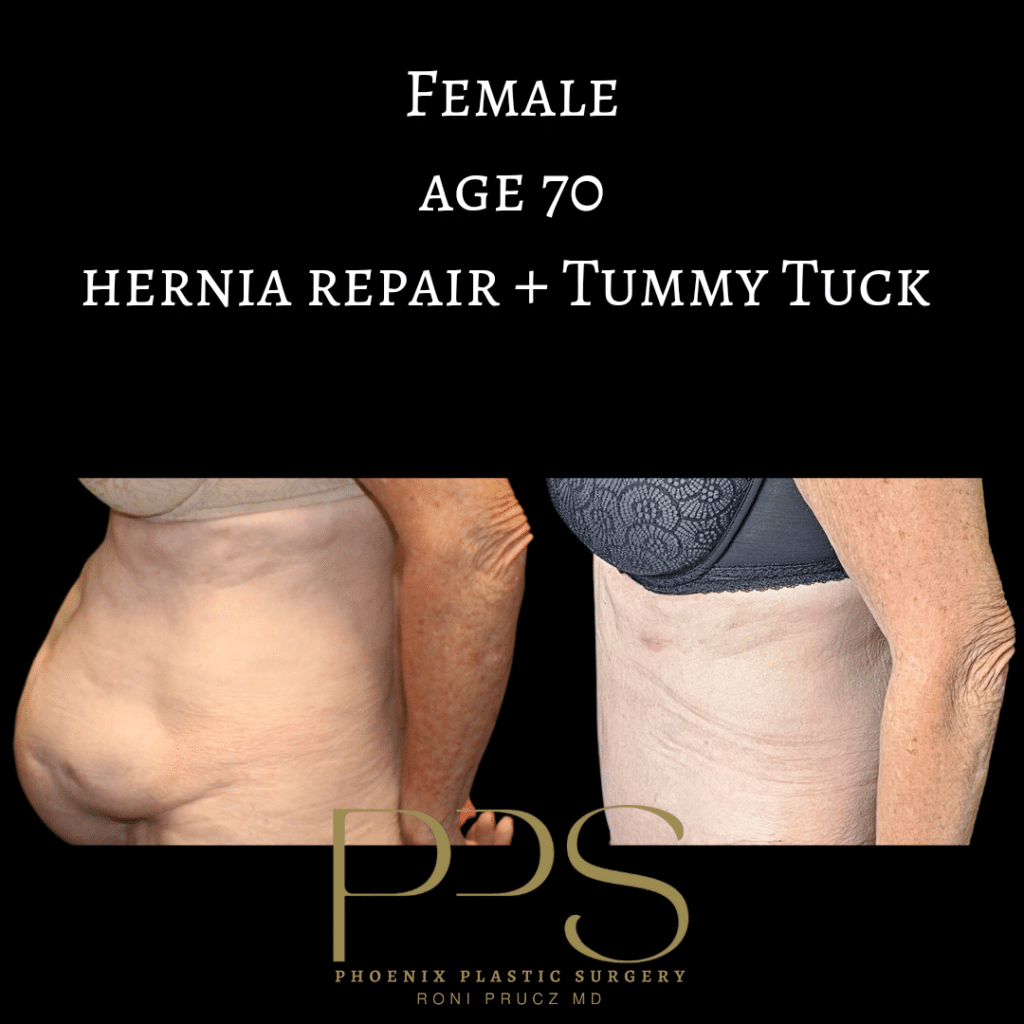 before-and-after-photograph-large-hernia-repair-with-tummy-tuck-lateral-view-70-year-old-female-phoenix-arizona