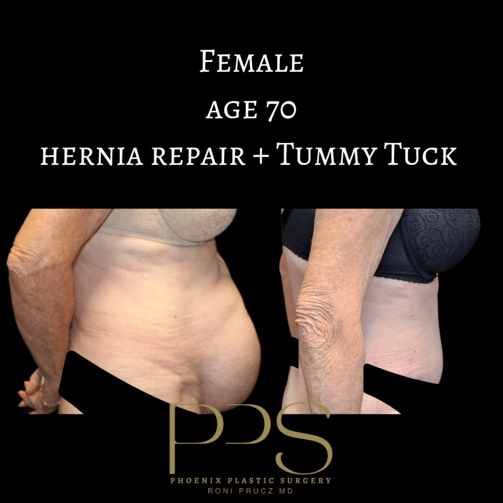 before-and-after-photograph-large-hernia-repair-with-tummy-tuck-lateral-view-70-year-old-female-scottsdale-arizona