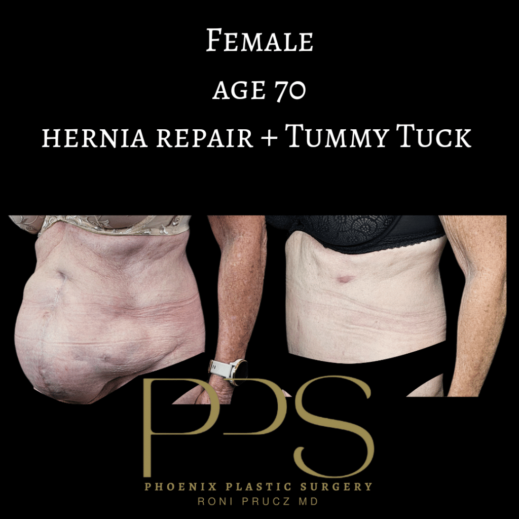 before-and-after-photograph-large-hernia-repair-with-tummy-tuck-oblique-view-70-year-old-female-scottsdale-arizona