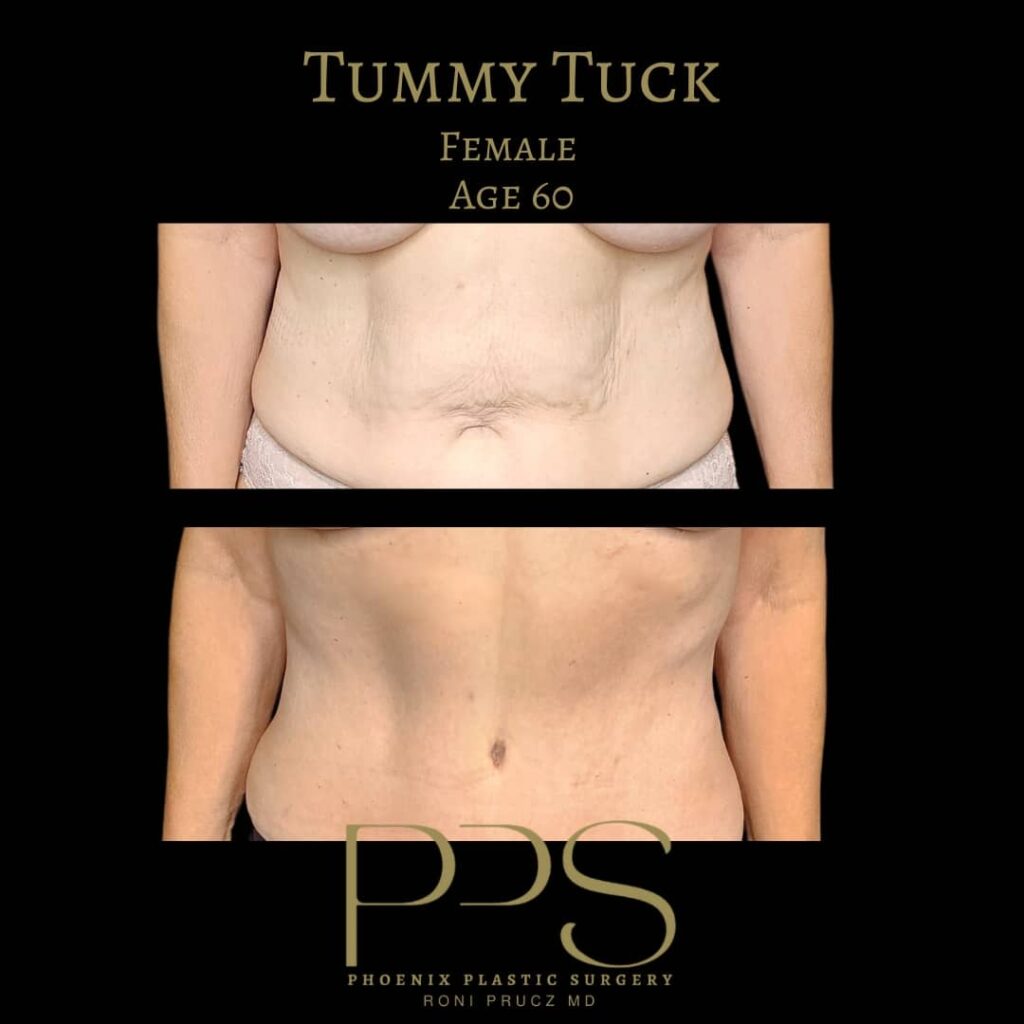 before-and-after-tummy-tuck-60-year-old-female-anterior-view-paradise-valley-arizona