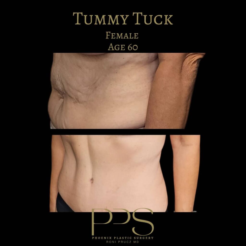 before-and-after-tummy-tuck-60-year-old-female-oblique-view-paradise-valley-arizona