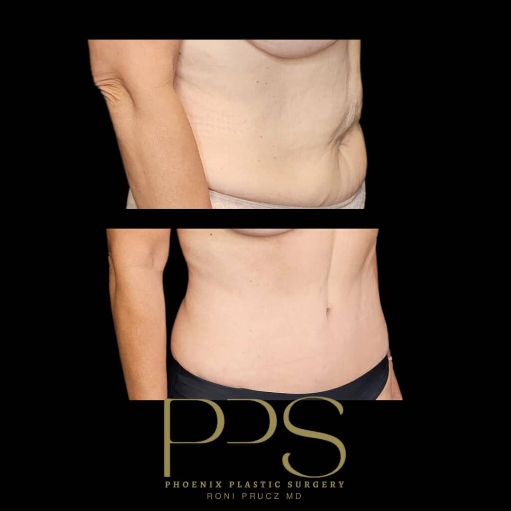 before-and-after-tummy-tuck-60-year-old-female-oblique-view-scottsdale-arizona