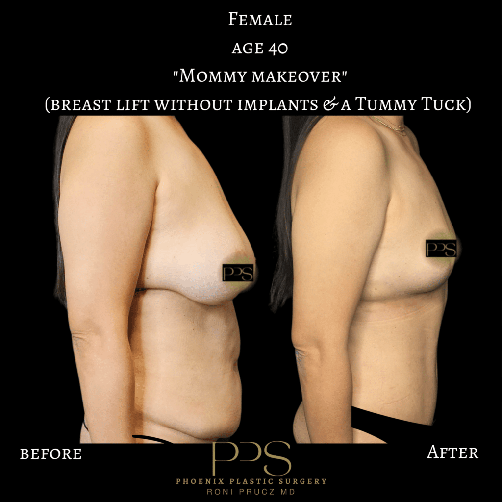 Before and After Photo Breast Lift without Implants and Tummy Tuck Lateral View Scottsdale Arizona